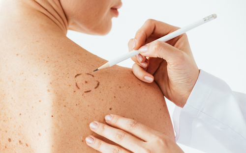 Skin cancer marked in a circle by a doctor pre-excision.
